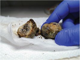 Gallstones removed from gallbladder