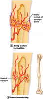 Bony callus formation and bone remodeling