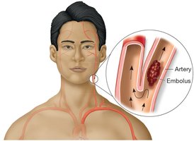 Embolus floating in artery