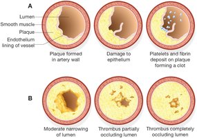 Development of atherosclerotic plaque