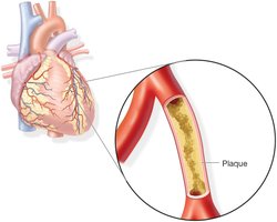 Atherosclerotic plaque in coronary artery