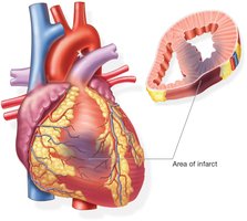 Infarct caused by myocardial infarction