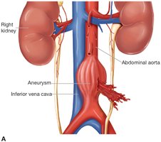 Large aneurysm in abdominal aorta
