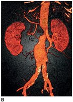 CT scan showing abdominal aorta aneurysm