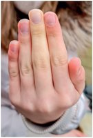 Raynaud phenomenon in hand