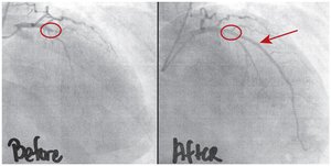 Coronary angiograms before and after stent placement