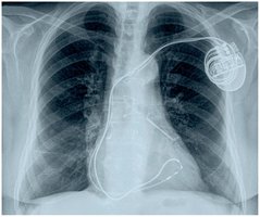 X-ray showing pacemaker implanted in chest