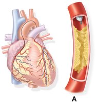 Balloon angioplasty approaching plaque
