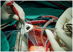 Prosthetic valve being implanted during open heart surgery