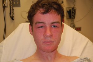 Facial swelling as a sign of allergic reaction