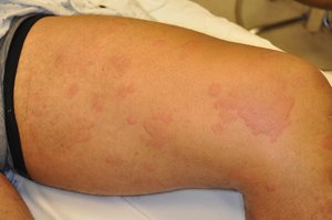 Hives (urticaria) on the skin as a sign of allergic reaction
