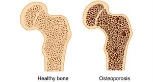 Healthy bone vs. osteoporotic bone
