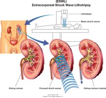 Extracorporeal shock wave lithotripsy