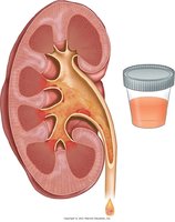 Hematuria: color of urine in specimen container