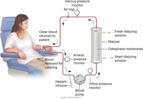 Hemodialysis machine schematic