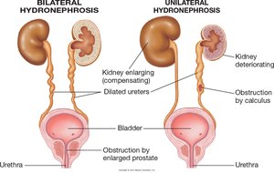 Hydronephrosis