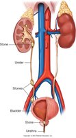 Renal calculi (stones) in urinary tract