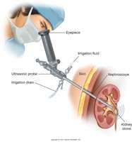 Percutaneous ultrasonic lithotripsy