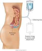 Peritoneal dialysis