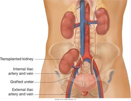 Placement of transplanted kidney