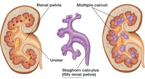 Urinary calculi