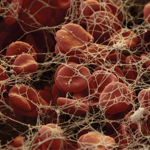 Electronmicrograph of a blood clot composed of fibrin, red blood cells, and tissue debris