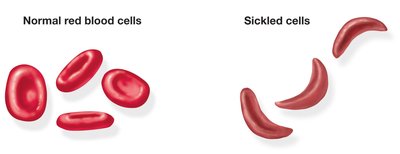 Comparison of normal-shaped erythrocytes and sickle-shaped cells in sickle cell anemia