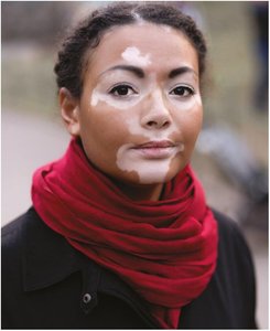 Vitiligo: irregular, expanding areas of depigmentation