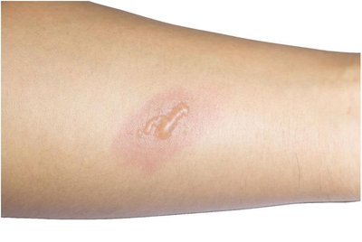 Partial-thickness burn with blister and bulla