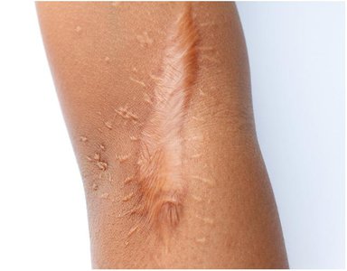 Keloid: large, raised scar