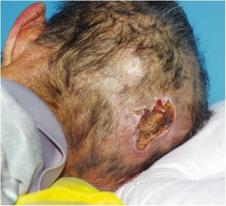 Pressure injury on the scalp