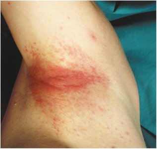 Severe contact dermatitis from deodorant