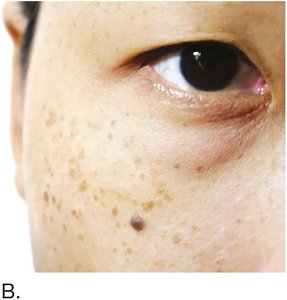 Flat, dark nevus (mole)