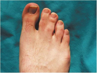 Syndactyly: fused toes