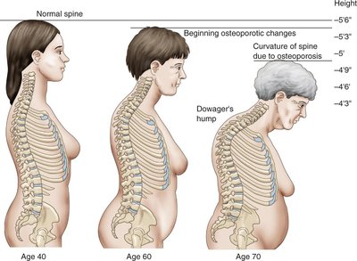Osteoporosis and spinal curvature changes with age