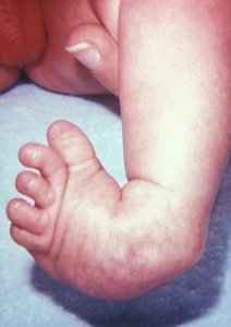 Talipes equinovarus (clubfoot) in an infant