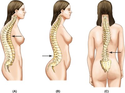 Abnormal curvatures of the spine: kyphosis, lordosis, scoliosis