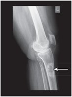 X-Ray Showing Osteogenic Sarcoma