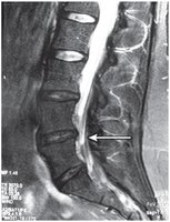 MRI Showing Herniated Lumbar Disk