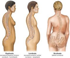 Abnormal Spinal Curvatures