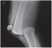 X-Ray Showing Complete Dislocation of Knee Joint