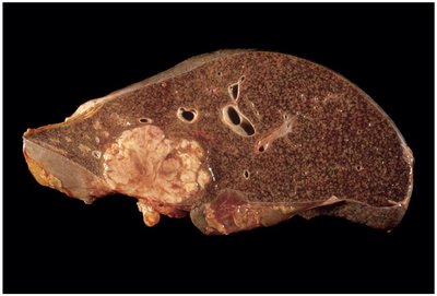 Liver with visible cancerous tumor at autopsy