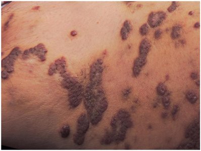 Kaposi sarcoma lesions on the skin
