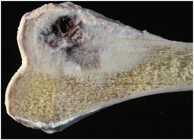 Osteosarcoma of the femur in a child