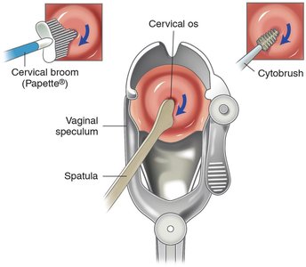 Pap test procedure for cervical cytology