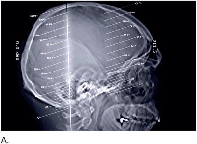 CT scan showing head slices