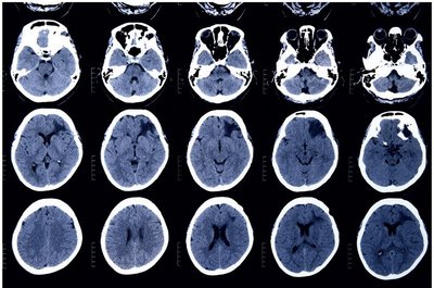 Multiple CT scan slices of the brain