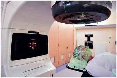 Patient receiving external beam radiotherapy with alignment mask