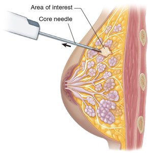 Core needle biopsy of the breast