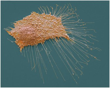 Cancer cell with cytoplasmic projections infiltrating tissue